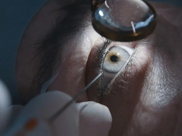 Patient and surgeon in operating room during ophthalmic surgery