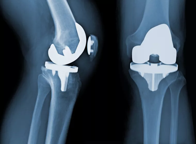 Osteoarthritis Before Total Knee Replacement X-ray