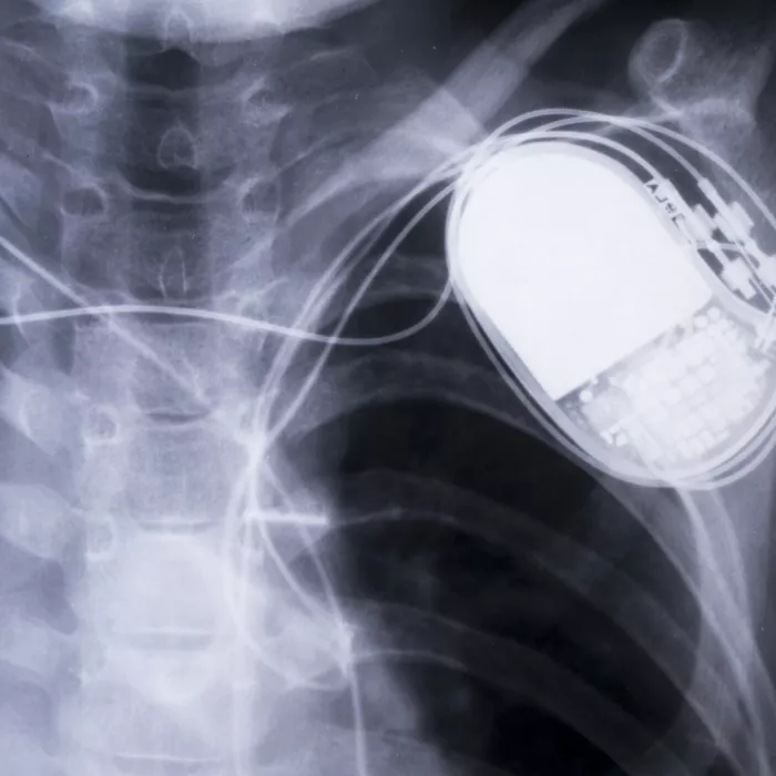 X-ray scan of a person's chest with a pacemaker