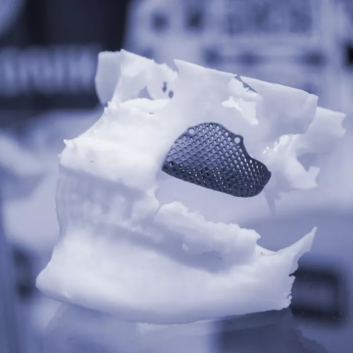 Prototype human jaw medical titanium implant from biocompatible titanium