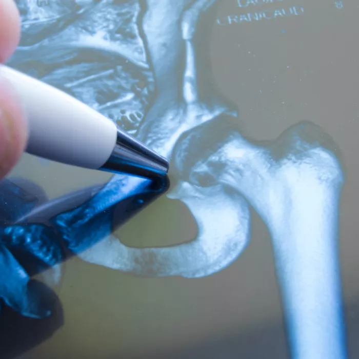 X-ray of hip joint