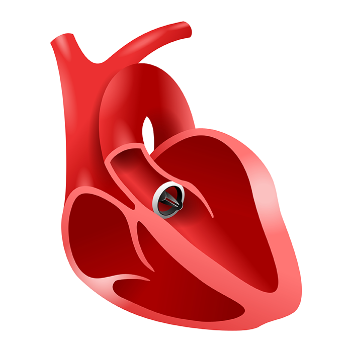 Artificial heart aortic bileaflet implant