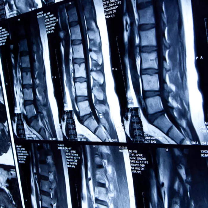 MRI scan of human lumbar spine