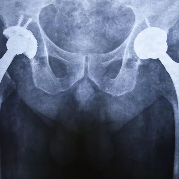 MRI Testing of Total Hip Replacement