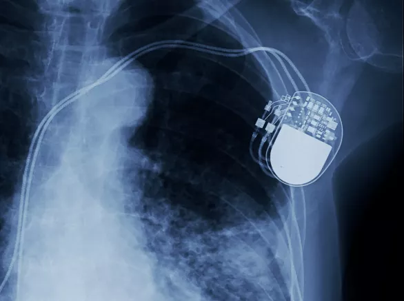 X-ray image of permanent pacemaker implant in chest body