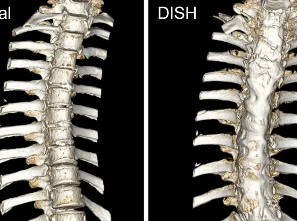 Spine Comparison