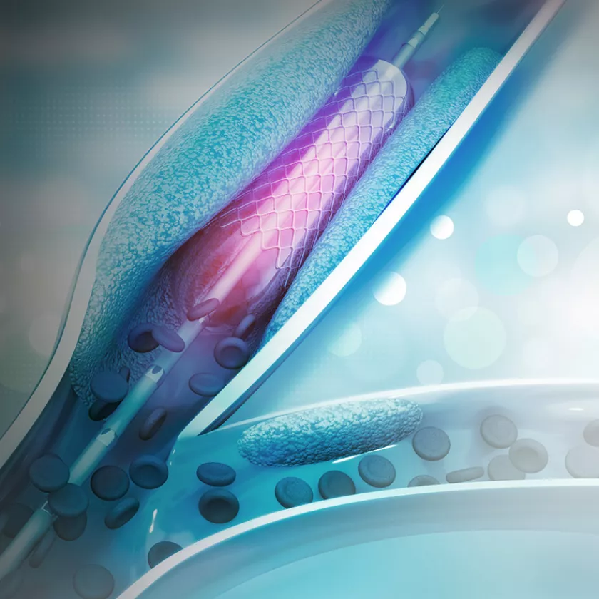 Upclose view of medical stent inside human veins. Exponent is a leader in health science innovation. 