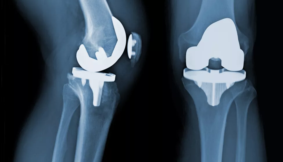 Osteoarthritis Before Total Knee Replacement X-ray