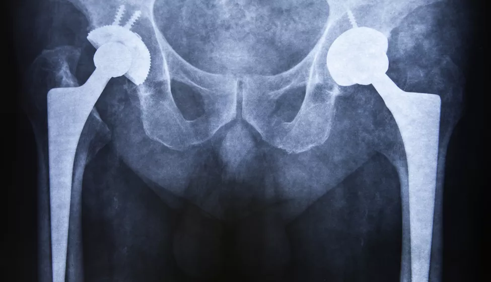 MRI Testing of Total Hip Replacement